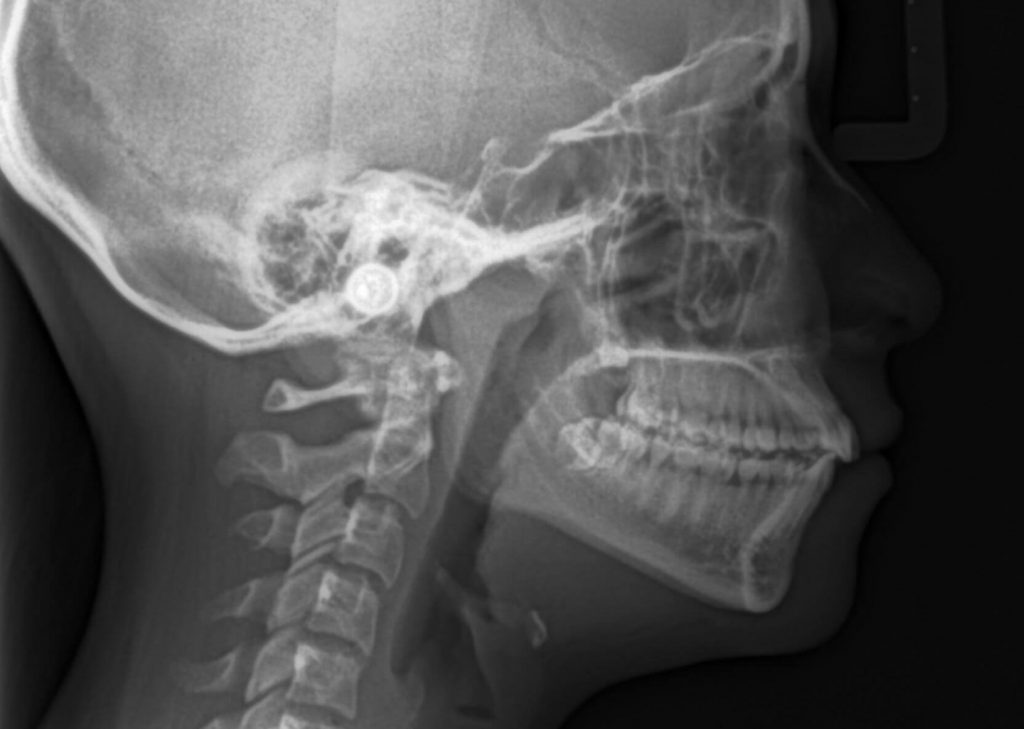 Radiografía de Perfil y Cefalometría